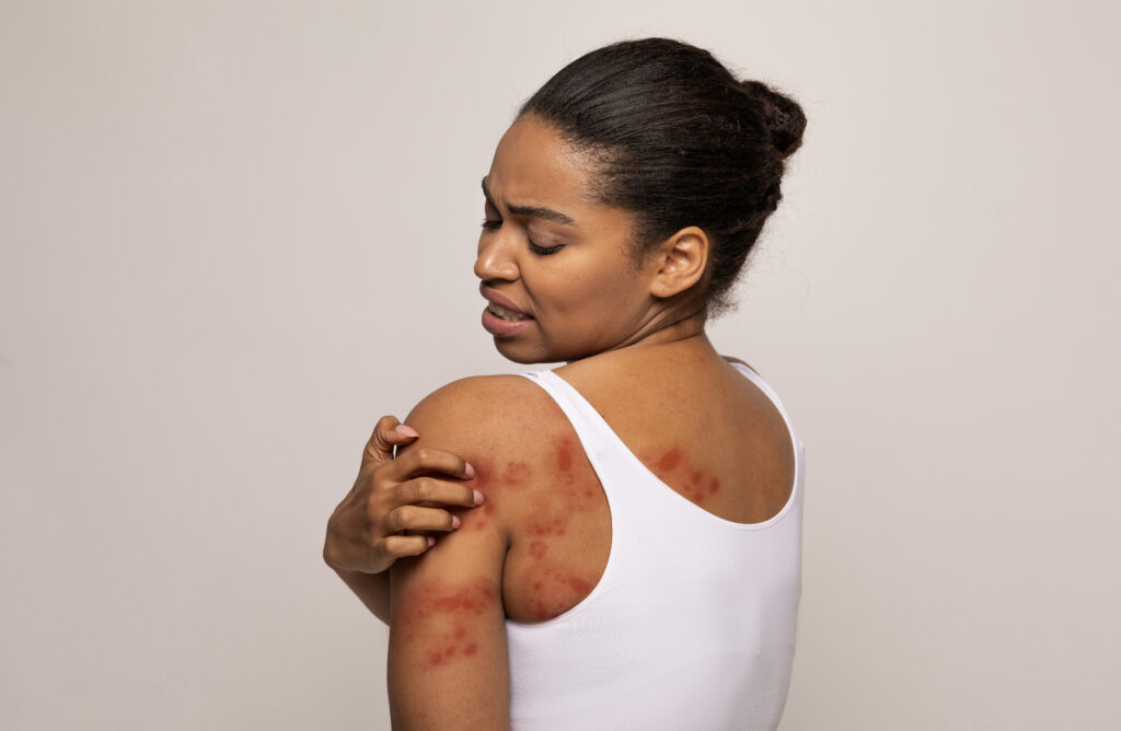 autoimmune disease psoriasis